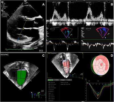 Autosomal dominant and autosomal recessive polycystic kidney disease: hypertension and secondary cardiovascular effect in children